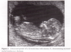 02 妊娠初期 胎児の頸部浮腫 Nt 妊娠11 13週でcheck 深谷産婦人科 医学情報